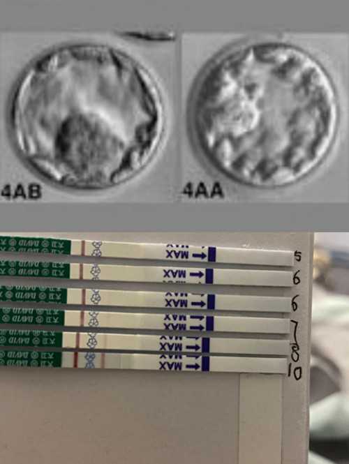 助孕双胞胎包成,试管婴儿促排要打针嘛？试管促排需要打几针？