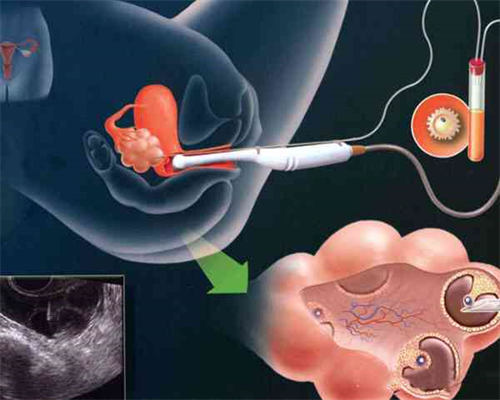 武汉洗精价格,排卵障碍可以在武汉协和医院做供卵代孕吗？成功率怎么样？